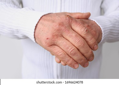 Close Up Of Male Hands With Dry Skin Damage. Dermatology Concept Human Hands With Skin With Cracks And Wounds. Human Hands Close Up