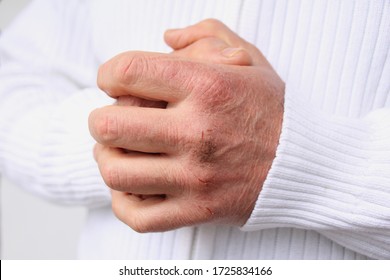 Close Up Of Male Hands With Dry Skin Damage. Dermatology Concept Human Hands With Skin With Cracks And Wounds. Human Hands Close Up