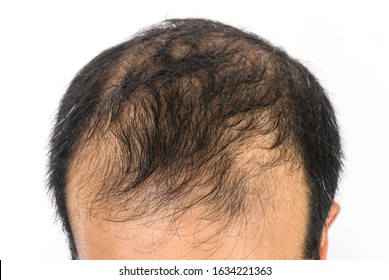 Male Pattern Baldness Images Stock Photos Vectors Shutterstock