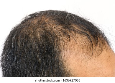 Male Pattern Baldness Images Stock Photos Vectors Shutterstock