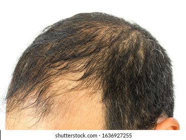 Male Pattern Baldness Images Stock Photos Vectors Shutterstock
