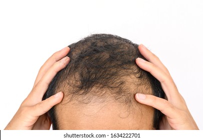 Male Pattern Baldness Images Stock Photos Vectors Shutterstock