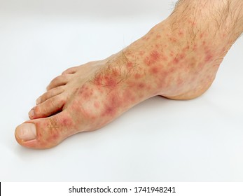 Close Up Of Male's Covid Foot And Toes With Red Rash Desease On A White Background. Stock Image.