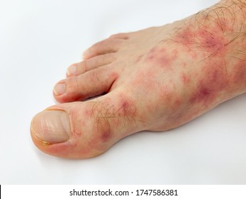 Close Up Of Male's Foot And Toes With Red Rash Desease On A White Background. Covid Toes Stock Image.