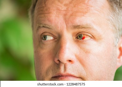 Close Up Of Man With Broken Blood Vessel In Eye. Subconjunctival Bleeding