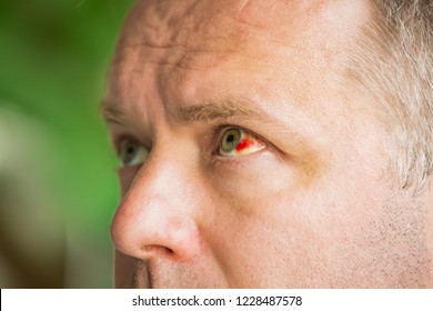 Close Up Of Man With Broken Blood Vessel In Eye. Subconjunctival Bleeding