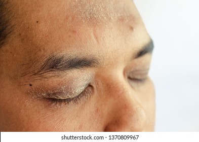 A Close Up Of Man Eyes And Forehead With Eczema Problem, Having Dry And Flaky Skin Around Eyes. Atopic Dermatitis Symptom Skin.