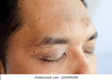 A Close Up Of Man Face With Eczema Problem, Having Dry And Flaky Skin Around Eyes, Forehead And Neck Area. Atopic Dermatitis Symptom Skin.