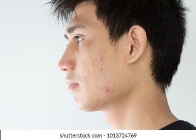 Close Up Of Man With Problematic Skin And Scars From Acne