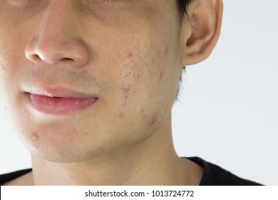 Close Up Of Man With Problematic Skin And Scars From Acne