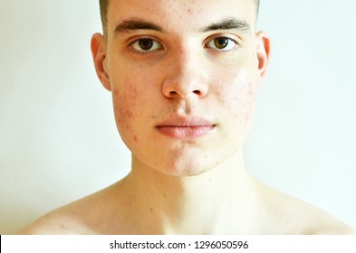 Close Up Of Man With Problematic Skin And Scars From Acne