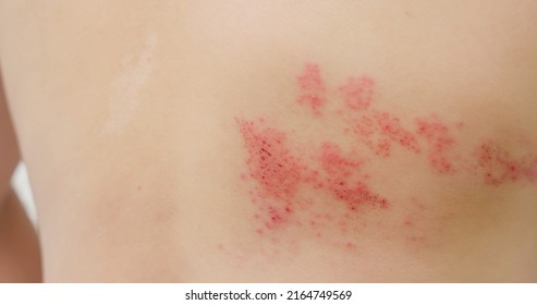 Close Up Of Man With Shingles Disease On Skin