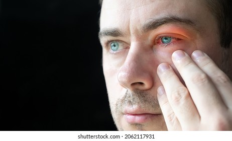Close Up of Man Touch His Severe Bloodshot Red Blood Eye Affected by Conjunctivitis or After Allergy. Man with Viral Blepharitis, Conjunctivitis, Adenoviruses. Irritated, Infected Eye. Copy Space