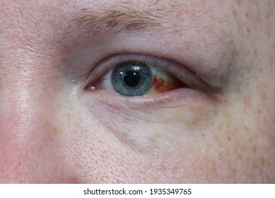 Close Up Of A Man's Bloodshot Eye.  A Ginger, White Male With Blue Eyes.  Macro Photo Of Eye Damage To The Sclera. Small Capillaries Are Shown Burst In The Whites Of The Eye. Selective Focus