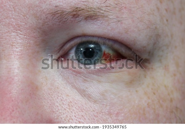 Close up of a man's bloodshot eye.  A ginger, white
male with blue eyes.  Macro photo of eye damage to the sclera.
Small capillaries are shown burst in the whites of the eye.
Selective focus