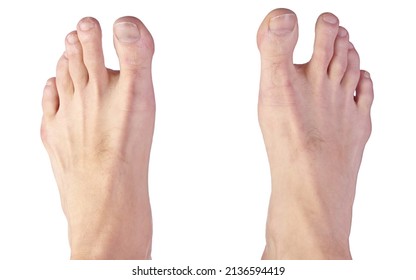 Close Up Of A Man's Feet Showing Sandal Gap Deformity, Also Known As Hallux Varus