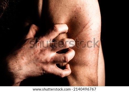 Close up of mans hand and fingers, clawing himself in depression and despair, with scratch marks from self harm.