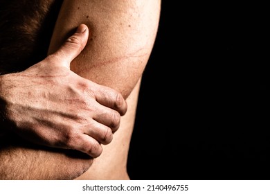 Close Up Of Mans Hand And Fingers, Holding Himself In Depression And Worry, With Scratch Marks. 