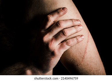 Close Up Of Mans Hand And Fingers, Holding Himself In Depression And Worry, With Scratch Marks. 