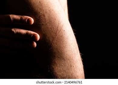 Close Up Of Mans Hand And Fingers, Holding Himself In Depression And Worry, With Scratch Marks. 