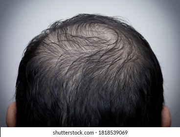 Close up man's head with hair loss, thinning hair or alopecia isolated on white background. Hair problem. 
