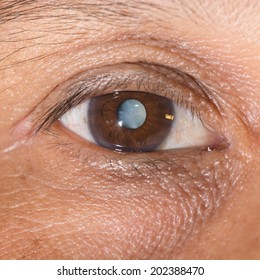 Close Up Of The Mature Cataract During Eye Examination.