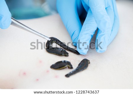 
Close up of medical leeches put on with tweezers on lumbar area. Hirudotherapy, Hirudo medicinalis.