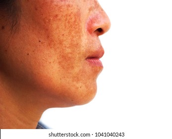 Close Up Melasma On Woman Face, Skin Problem