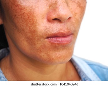 Close Up Melasma On Woman Face, Skin Problem