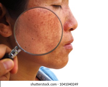 Close Up Melasma On Woman Face, Skin Problem