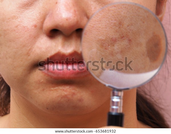 Nahaufnahme Der Melasma Haut Durch Lvergrosserung Von Stockfoto Jetzt Bearbeiten