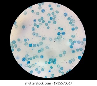 Close microscopic view of abnormal reticulocyte count in hematology department, 100x, methylene blue staining