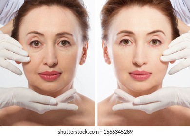 Close up middle age woman macro face before after collagen injection. Face lifting, anti aging concept. Plastic surgery, cosmetic facelift with bone contouring. Wrinkled face before-after treatment