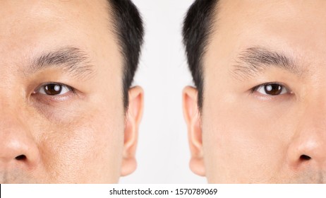 Close Up Of Middle Aged Asian Man Face With Wrinkles, Sun Damage, Dark Circles Under The Eyes, Before And After Procedures.