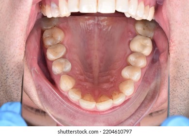 Close Up Mirror Picture Sick Teeth Open Mouth Dentist Examination Treatment