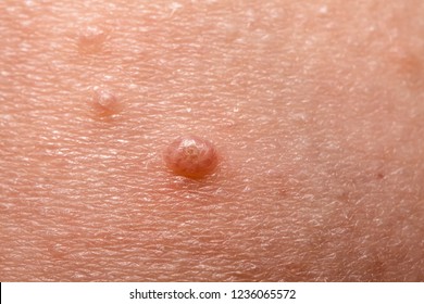 Close up of Molluscum Contagiosum also called water wart.