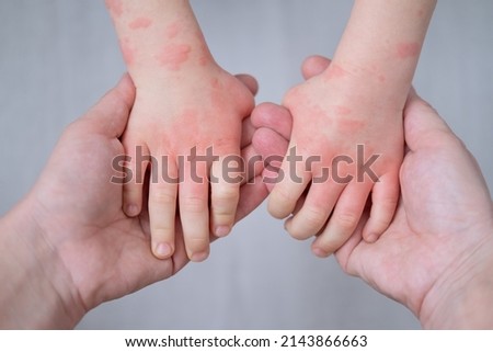 close up mother holding kids hands with allergic rash or eczema. severe allergic reaction, atopic skin
