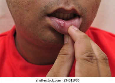 Close Up Of Mouth Ulcer,selective Focus