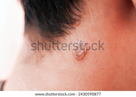 Close up multiple oval papule with collarette scale of Secondary stage syphilis sores on neck skin.