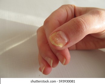 Nail Fungus Hd Stock Images Shutterstock