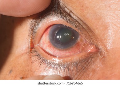 Resultado de imagem para glaucoma