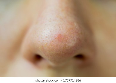 Close Up Of A Nouse With Clogged Pores With Blackheads