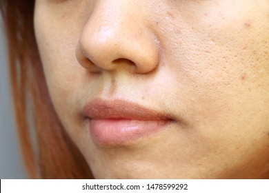 Close Up Oily Face And Have Problem Skin (wide Pores) Of Asia Woman