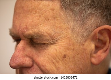 Close Up Old Caucasian Man Forehead, Face And Hair And  Wrinkle Line On His Forehead Skin. Hyperpigmentation On Old Man Skin. Many 