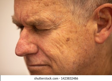 Close Up Old Caucasian Man Forehead, Face And Hair And  Wrinkle Line On His Forehead Skin. Hyperpigmentation On Old Man Skin. Many 