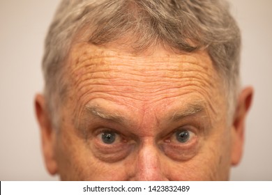 Close Up Old Caucasian Man Forehead, Face And Hair And  Wrinkle Line On His Forehead Skin. Hyperpigmentation On Old Man Skin. Many 