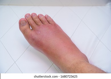 Close Up Old Man Right Foot, Ankle Wounded Waiting And Swelling Infectious Disease By Bee Sting Allergic Reactions Nurse Treatment On Wound Dressing A Bloody And Brine Of Patient On White Background.