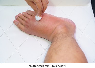 Close Up Old Man Right Foot, Ankle Wounded Waiting And Swelling Infectious Disease By Bee Sting Allergic Reactions Nurse Treatment On Wound Dressing A Bloody And Brine Of Patient On White Background.