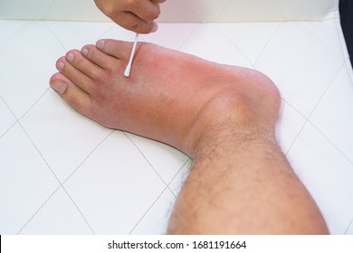 Close Up Old Man Right Foot, Ankle Wounded Waiting And Swelling Infectious Disease By Bee Sting Allergic Reactions Nurse Treatment On Wound Dressing A Care And Brine Of Patient On White Background.