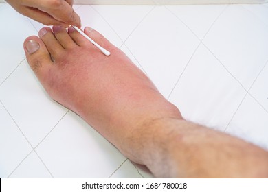 Close Up Old Man Right Foot, Ankle Wounded Waiting And Swelling Infectious Disease By Bee Sting Allergic Reactions Nurse Treatment On Wound Dressing A Care And Brine Of Patient On White Background.